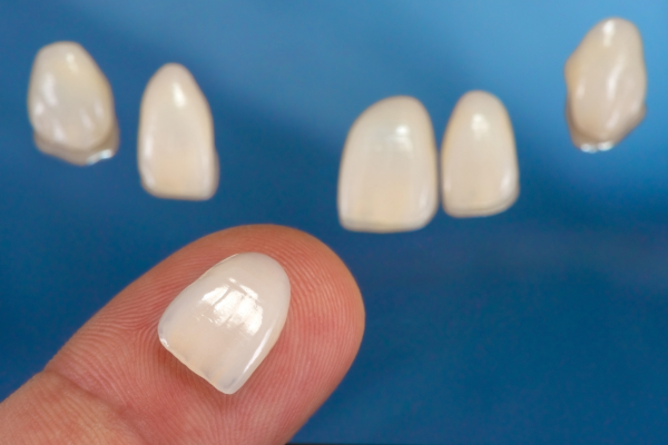 Dental veneers