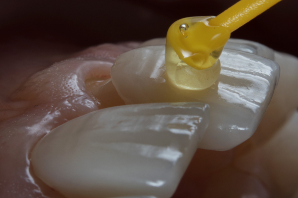 Porcelain dental veneers