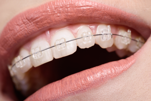 Ceramic braces or tooth-colored braces on a patient of Dr. Haselhorst's Naperville dental office.