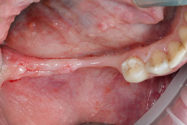 The lower jaw of someone who needs a bone grafting procedure.