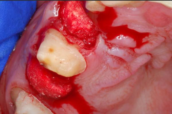 The gumline after a bone grafting procedure.