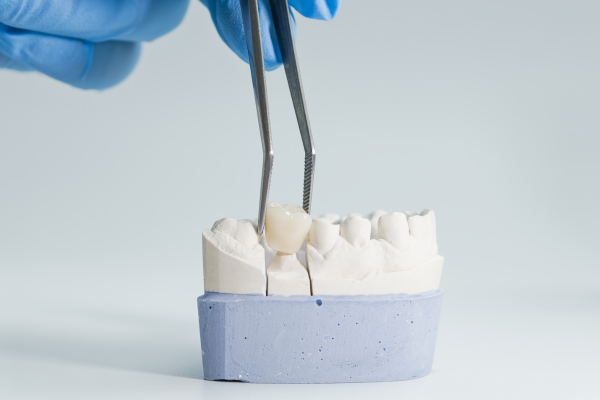 A dental crown being placed on a resin tooth model.