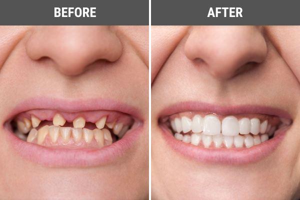 A before and after comparison of a person with dental crowns.