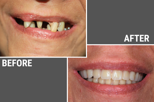 Before and after comparison of a patient who had fixed dentures placed in our Naperville dental office.