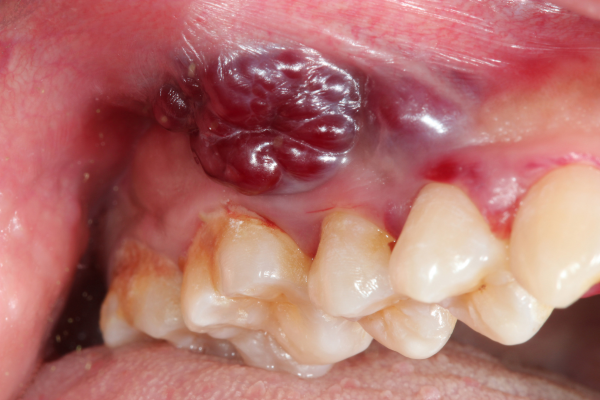 An oral sarcoma.