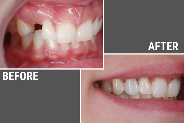 Before and after photo of a woman who had a single tooth replacement at Dr. Joe Haselhorst's Naperville dental office.