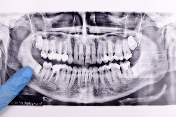 Dentist pointing out the wisdom teeth on an x-ray.