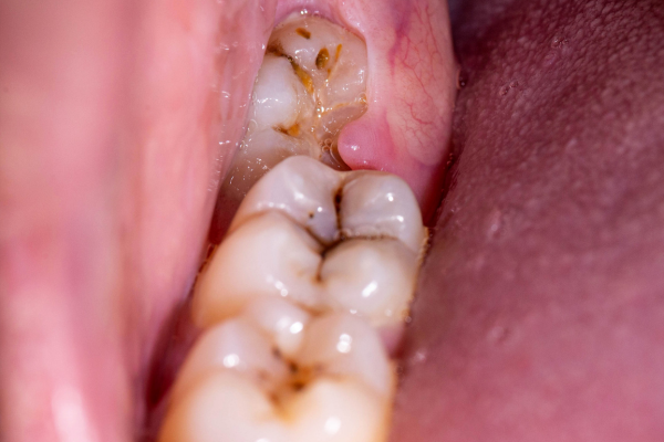 An impacted wisdom tooth.