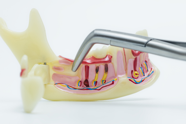 A model of the lower jaw, showing anatomy and nerves.