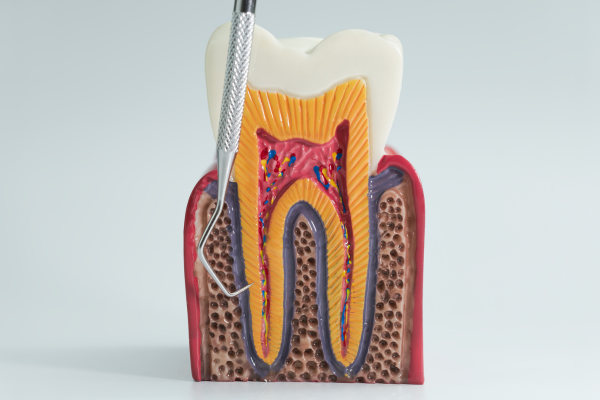 A model of the inside of a tooth showing the nerve going down into the root.